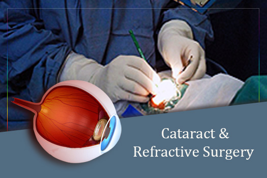 cataract