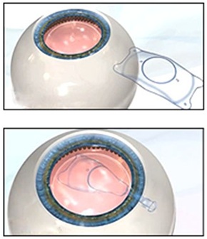ICL (Implantable Contact Lens)