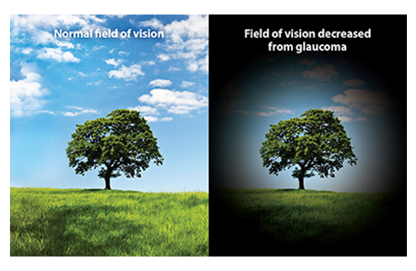 Symptoms of Glaucoma
