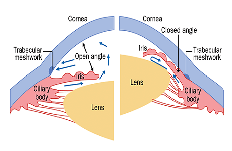 Glaucoma