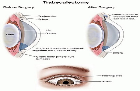 Surgery - Trabeculectomy