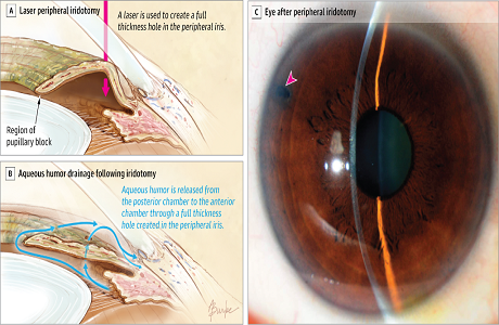 Peripheral iridotomy