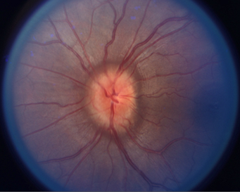 Neuro Ophthalmology