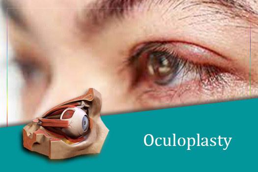 oculoplsty