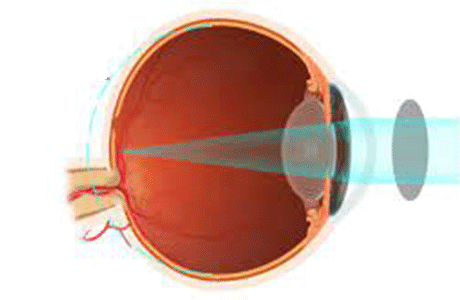 Childhood refractive errors
