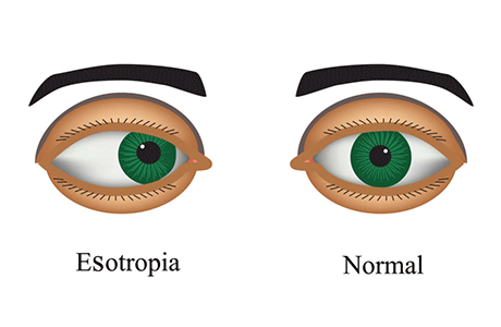 Squint / Strabismus
