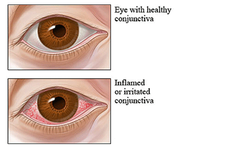 Allergic eye disease