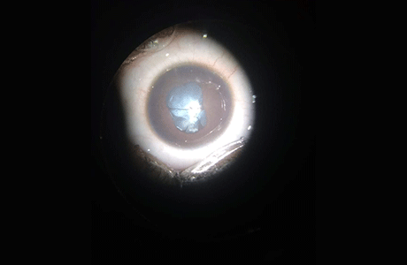 Childhood cataract