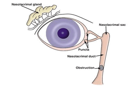 Congenital lacrimal duct obstruction