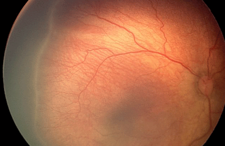 Rop-retinopathy of prematurity screening