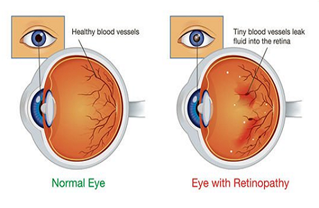 Vision Loss due to DME